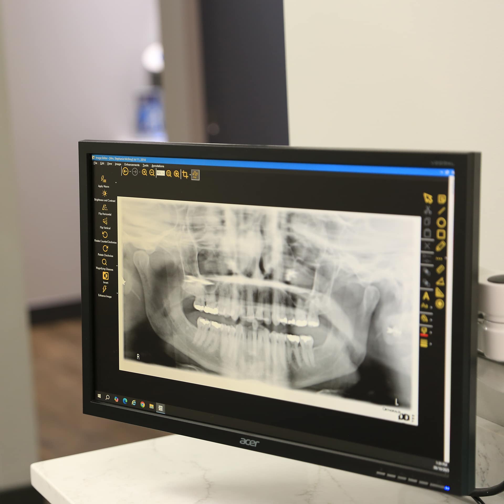 Tooth Extraction - Pitt Meadows